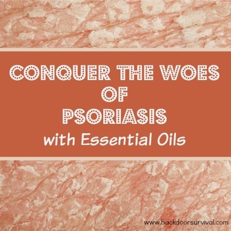 Treating Psoriasis with Essential Oils - Backdoor Survival